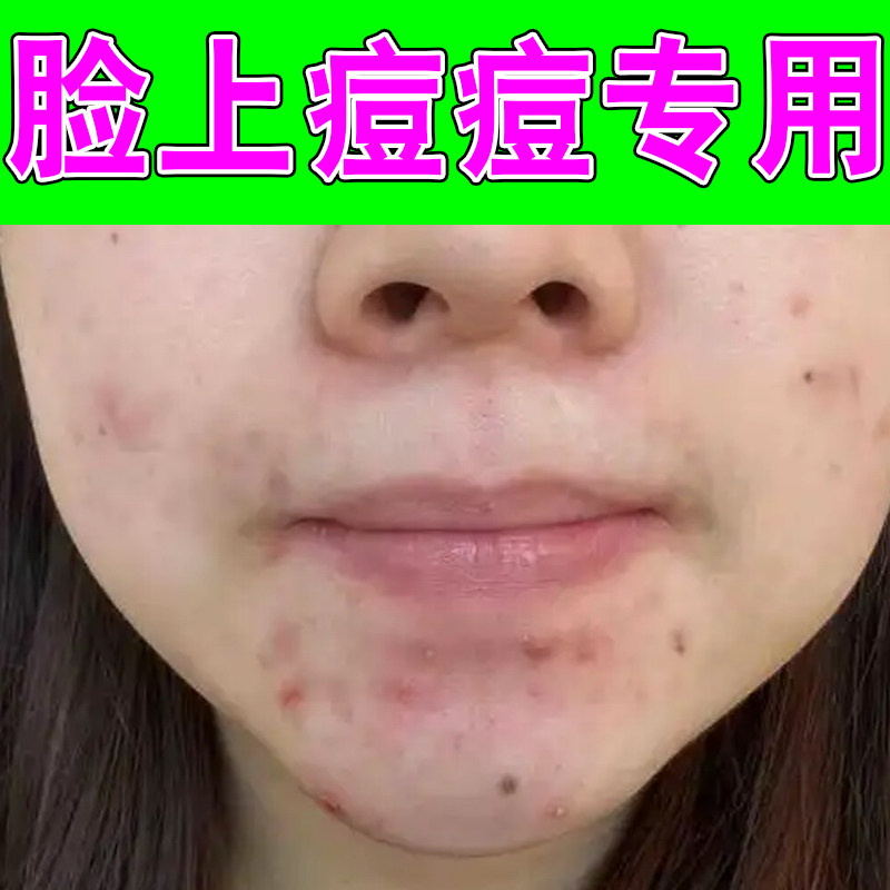 脸上痘痘专用男女通用上火熬夜痘内分泌十条脸颊反复长痘额头痘痘