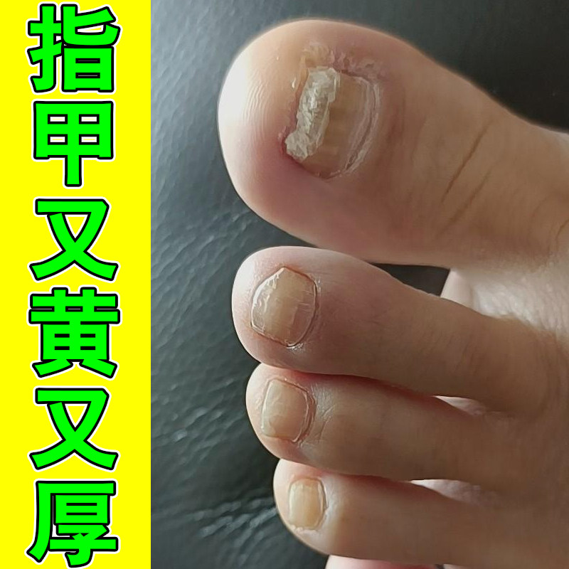 指甲变硬增厚发黄分层手脚空甲甲肉分离感染凹凸不平温和养护药液