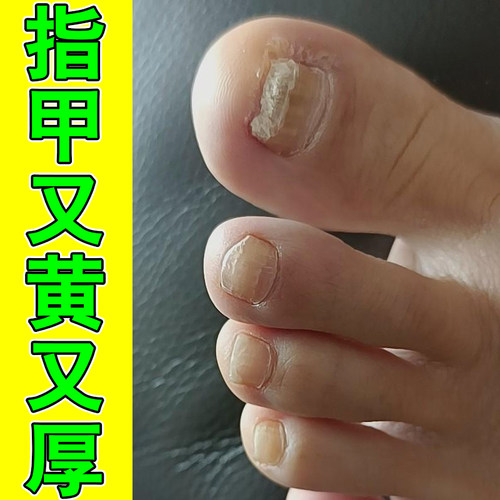 指甲变硬增厚发黄分层手脚空甲甲肉分离感染凹凸不平温和养护药液