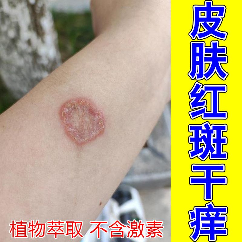皮肤红斑干痒身上皮肤粗糙掉屑起圆斑疙瘩痘换季神经性感染专用膏