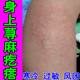 冶身上荨麻疙瘩皮肤过敏痒换季 风团顽固慢皮肤痒起红疙瘩药乳