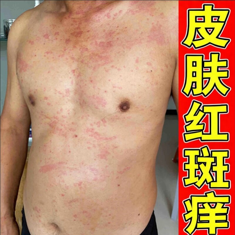 蜘蛛疮后背上长水泡水痘带状疱皮肤专用修复药