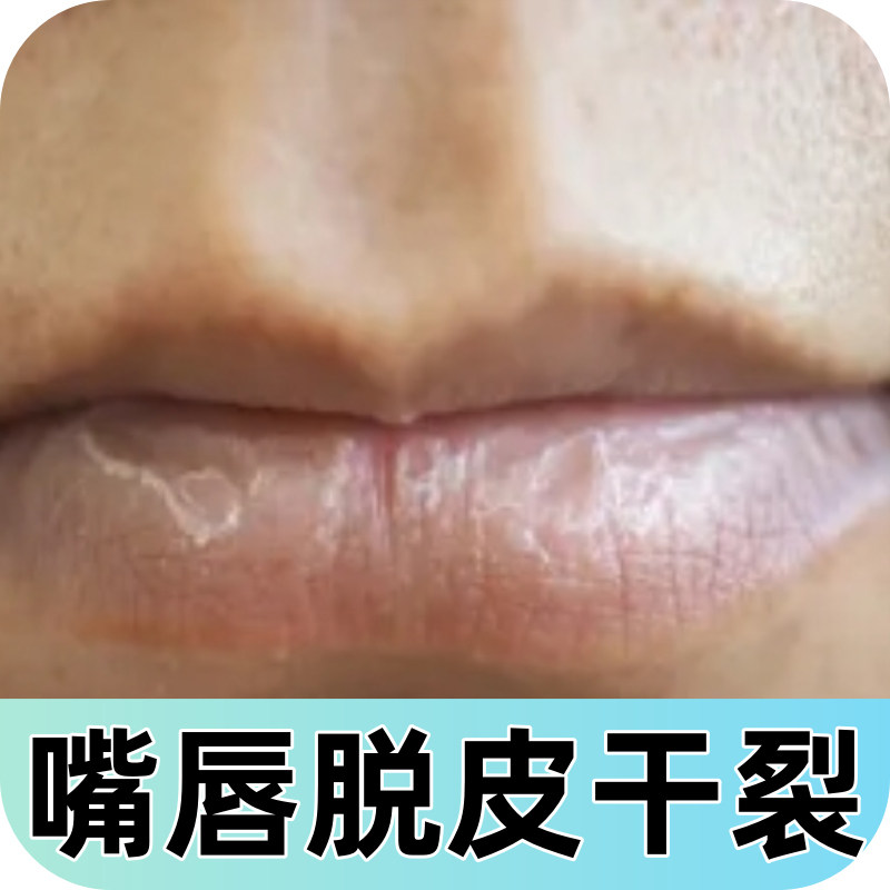 嘴角水疱口唇药儿童成人专用软膏嘴巴上火起泡烂红肿修复羊胡子疮