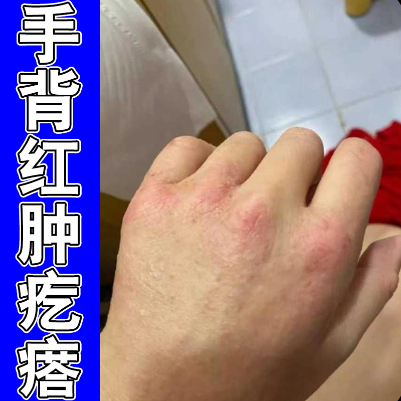 手背红肿疙瘩沙土性手上起小疙瘩鳞屑痒掉屑脱皮皮肤干燥粗糙外用