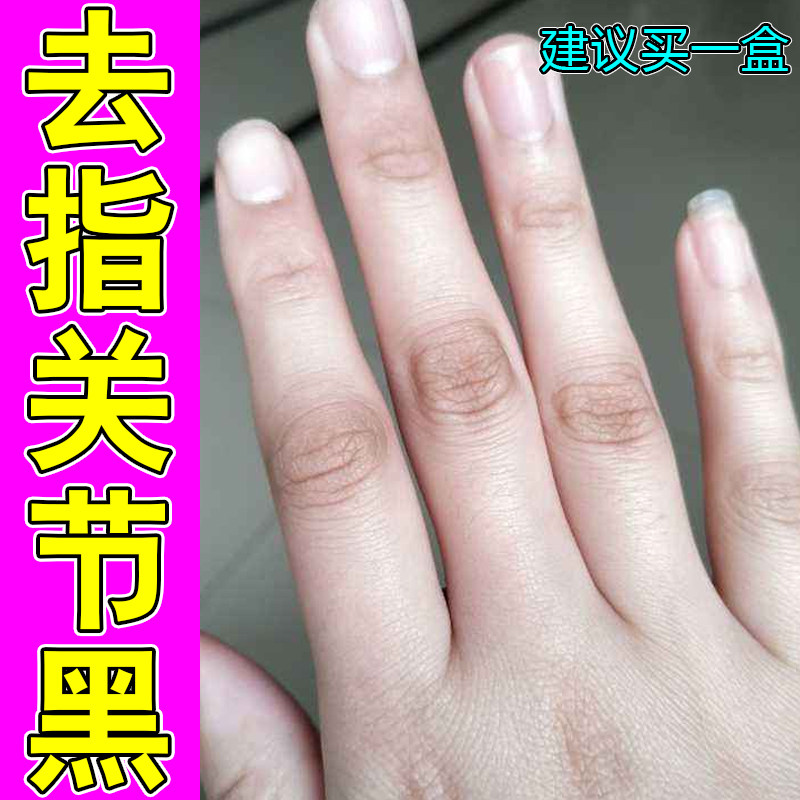 去指关节黑暗沉色素沉淀角质层增厚皮肤干燥手部干纹起皮外用修护
