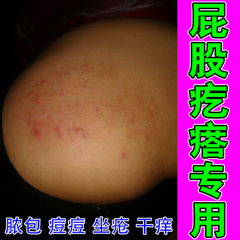 屁股疙瘩长痘痘起热毒疙瘩坐板疮红肿痒屁股火疖子脓包脓药