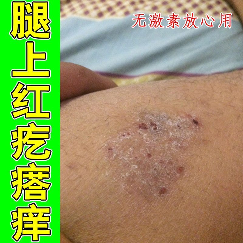 腿上红疙瘩痒掉屑粗糙干燥痒神经性皮肤过敏痒老年人身上痒硬疙瘩