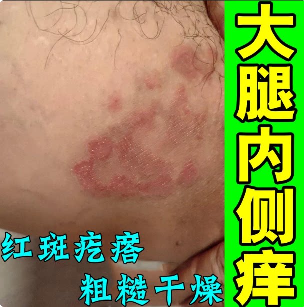 大腿内侧潮痒男士阴囊痒私处干长红斑起皮掉屑粗糙痒疙瘩痒修复药