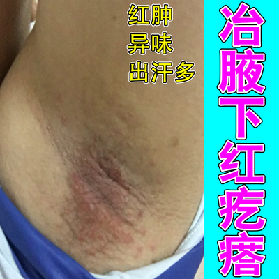 腋下褶皱处泛红潮湿摩擦不适出汗后黏腻刺痒腹股沟冶大腿内侧红痒