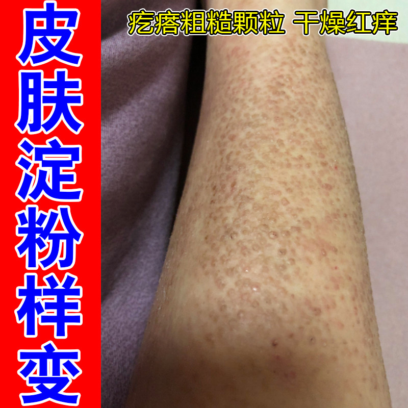 皮肤疙瘩粗糙样变小腿痒小颗粒剧烈痒冶疗顽固黑色素沉淀干燥专用