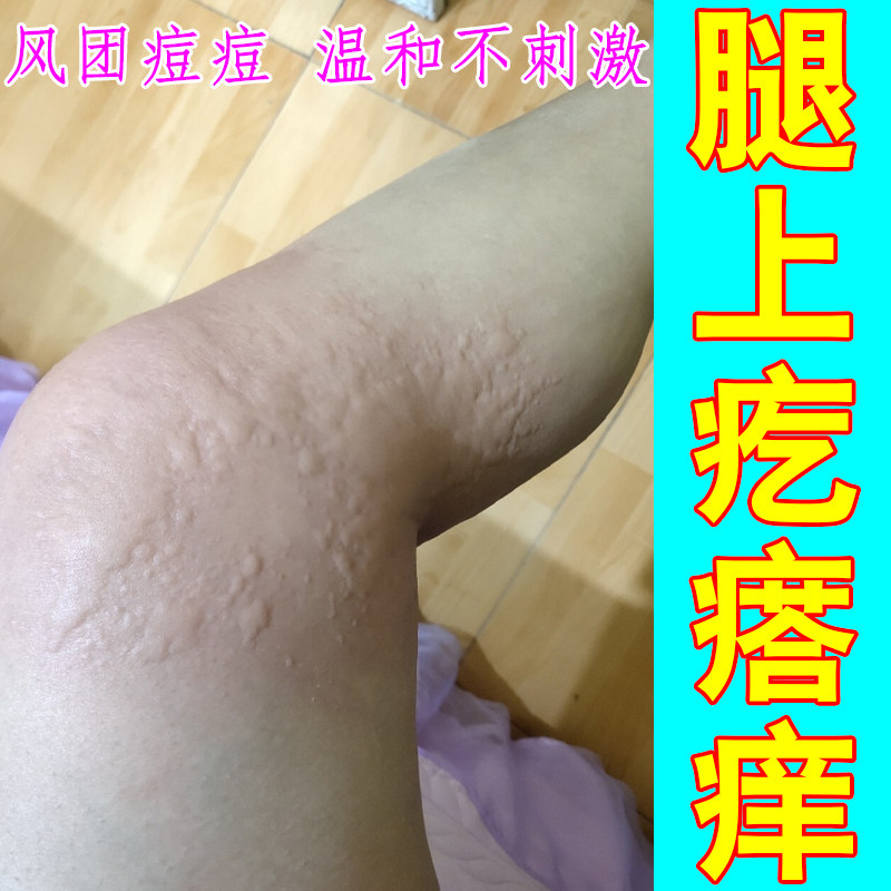 腿上疙瘩痒寒冷性起风团大腿胳膊长痘痘大块红肿过敏痒专用草本膏