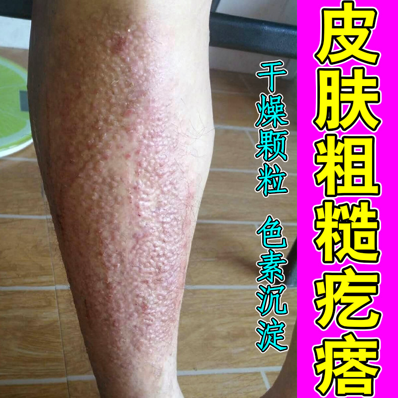 皮肤粗糙疙瘩顽固颗粒褐色斑点小腿痒改善黑色素沉淀顽固后背干痒