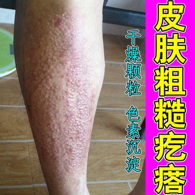 皮肤粗糙疙瘩顽固颗粒褐色斑点小腿痒改善黑色素沉淀顽固后背干痒