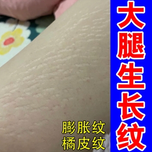 去肥胖纹修复霜生长纹消除学生大腿淡化妊娠纹精油祛紧致肚皮膏