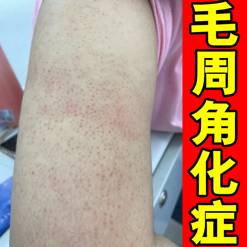 毛周角化症皮肤毛囊胳膊起疙瘩长红点皮肤毛囊堵塞专用修复药