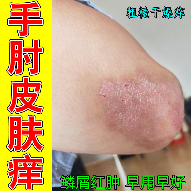 手肘皮肤痒长红斑剧烈痒老年人身上起红肿疙瘩痘鳞屑掉屑增厚角质