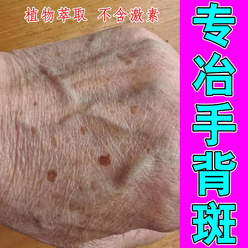 冶中老年手上斑护理膏手背肌肤暗沉护理改善手部肤色不均日常润肤