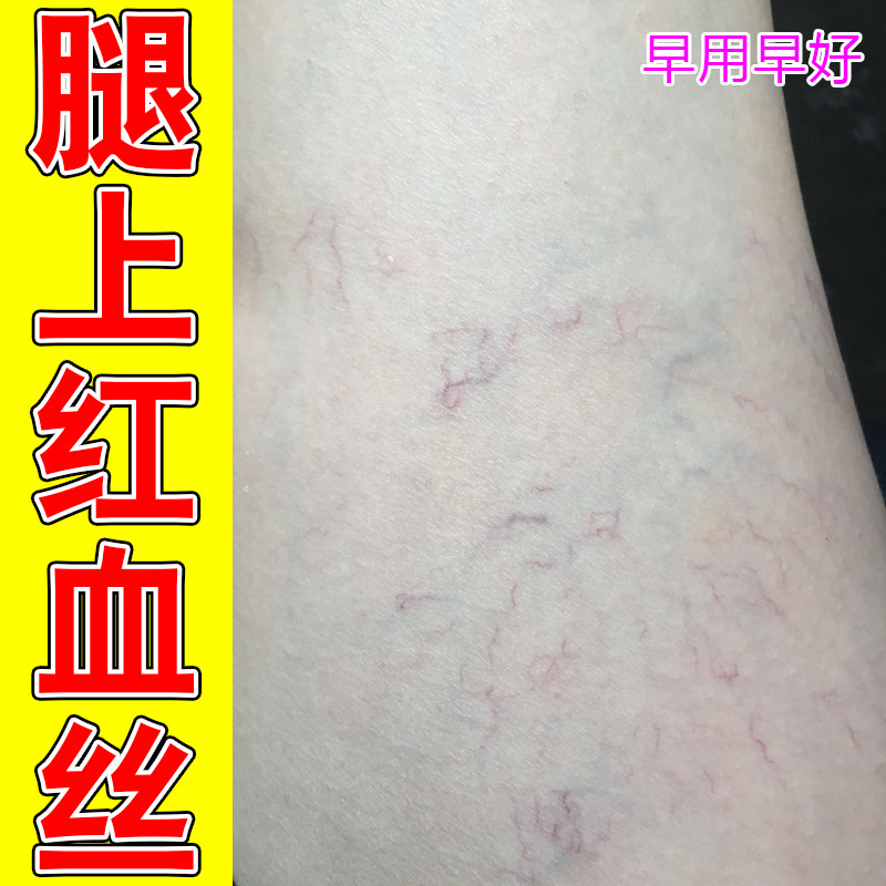 腿上网状红血丝小腿血管显露下肢腿部沉重酸胀腿部丝状红纹外用药