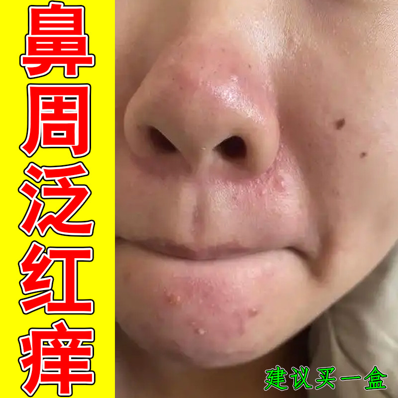 鼻周泛红痒螨虫鼻起皮干燥掉屑痒脂溢性鼻子两边干痒红鼻头修护药