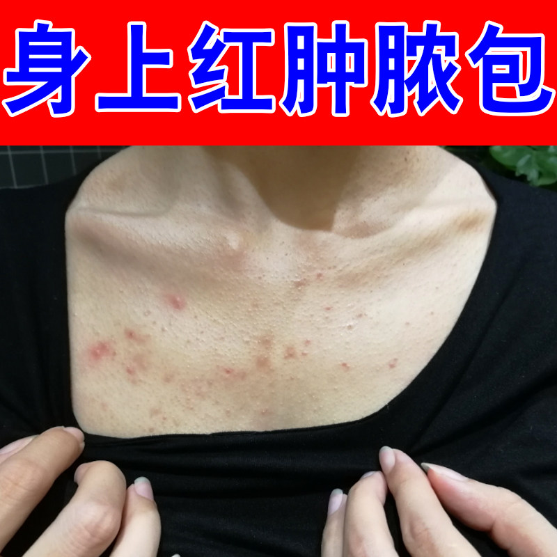 胸前痘痘胸口发红发痒长小红点疙瘩背上脓包前胸后背痘马拉色菌痒