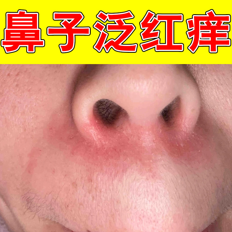 鼻子泛红痒鼻翼起皮螨虫鼻脱皮脂溢性皮肤干燥粗糙掉屑红肿外用药