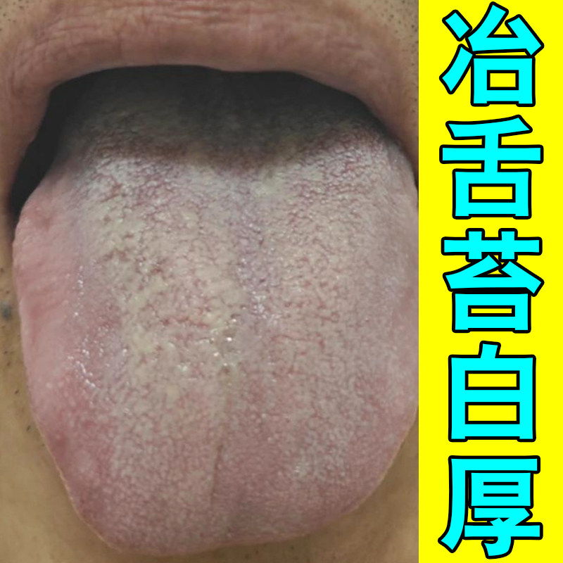 冶舌苔白厚舌头裂纹有齿痕地图舌中间黄厚腻调理儿童灼口综合征药