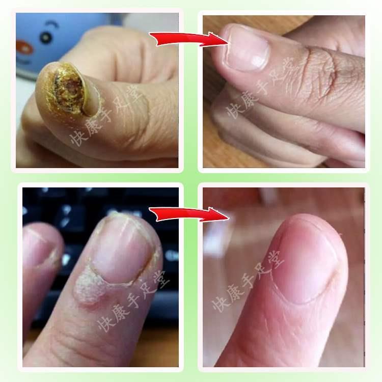 滴优趾跖忧净寻常尤刺猴子肉刺鸡丁眼老茧脚垫止忧敌扁平灵赘生物