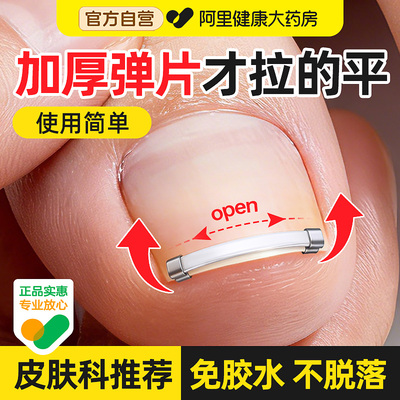 【修甲店同款】甲沟矫正器