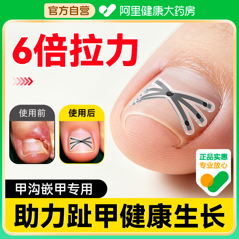 【医研级】无感矫正甲沟矫正