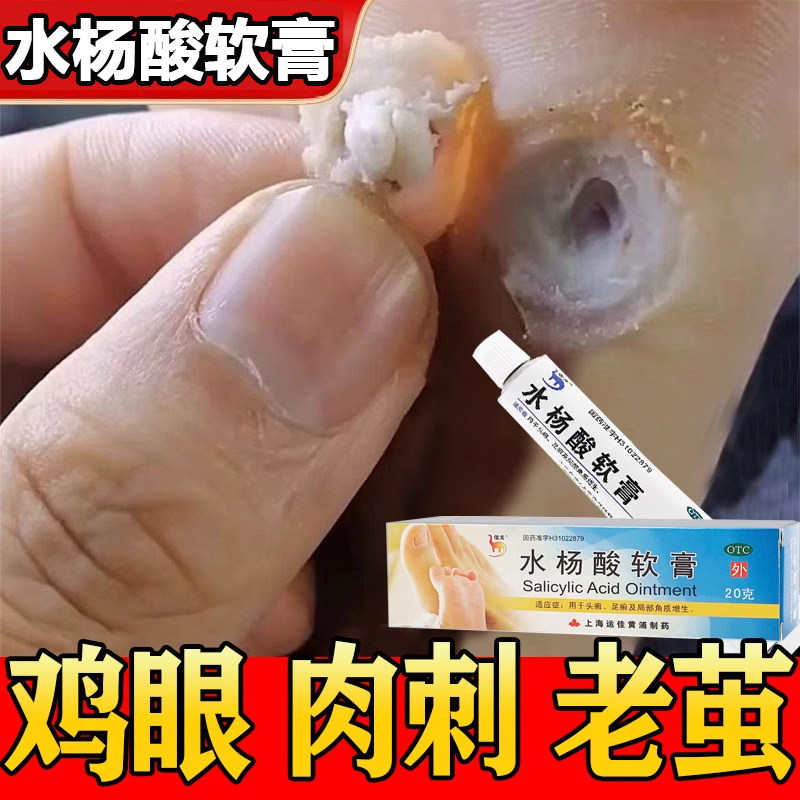 去鸡眼足癣脚气止痒杀菌脱皮药膏水杨酸软膏乳膏去角质官方旗舰店