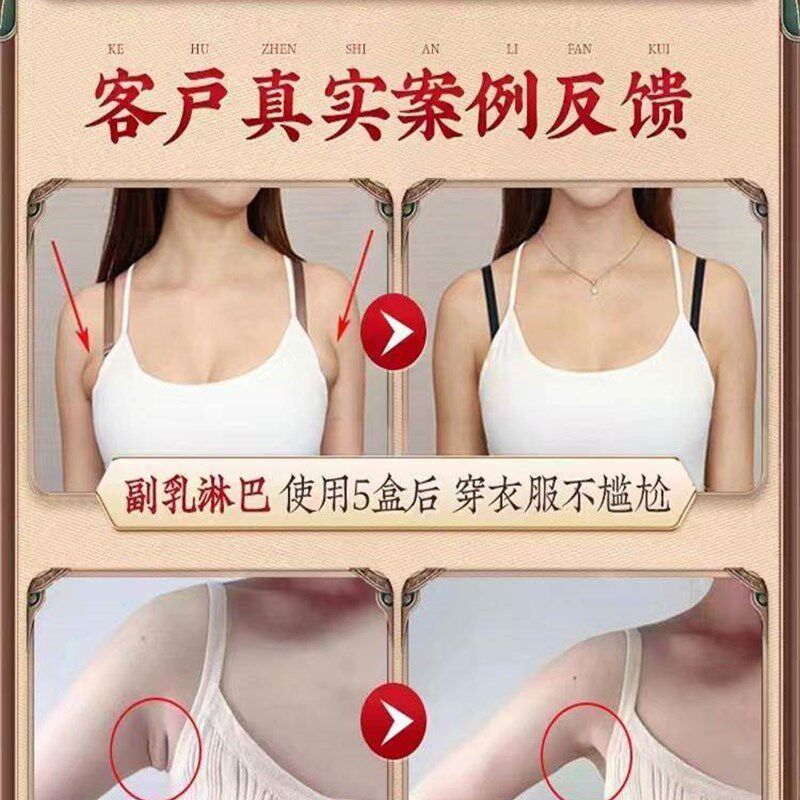 极速【200%管用】淋巴结消散结膏D脖子肿专科用疏通神器副乳去消