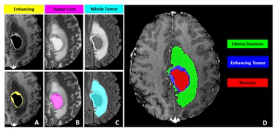DL00238-2D脑肿瘤分割数据Brats2021resnet和swin transformer