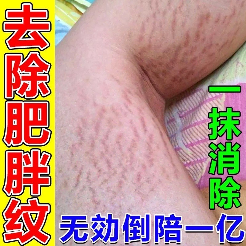 去肥胖纹修复霜生长纹消除学生大腿淡化妊娠纹屁股祛紧致膏去除男