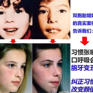 极速口呼吸矫正器训o练突嘴增强唇肌闭合力量功能矫治夜防张嘴上