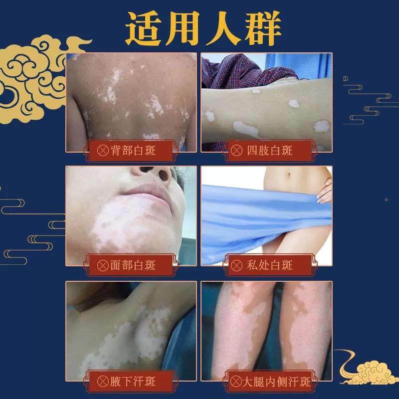 极速手足白癜风消白黑色r素生长白癫疯风外用药软膏老人白斑遮盖