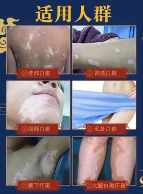 极速手足白癜风消白黑色r素生长白癫疯风外用药软膏老人白斑遮盖