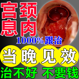 子宫内膜息肉药内膜太厚中药调理宫颈纳囊肥大肌瘤专用去除宫舒贴