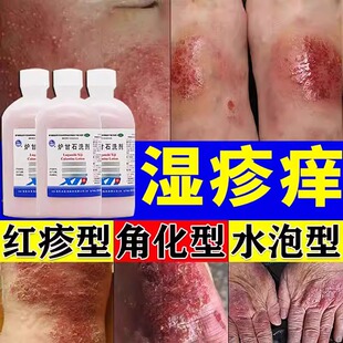 炉甘石洗剂治皮肤湿疹止痒去顽皮炎真菌感染止痒特新固效专治用药
