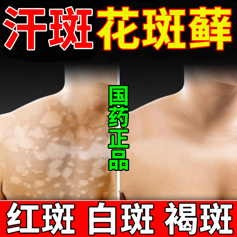 克霉唑乳膏汗斑净除汗斑花斑癣专用药膏皮肤瘙痒真菌感染止痒药膏