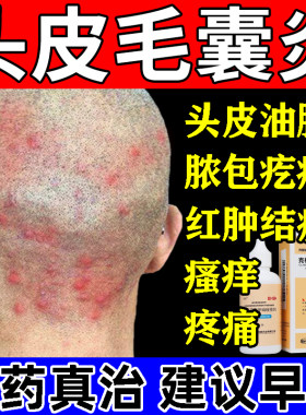 毛囊炎头部专用药膏脂溢性皮炎治疗头部痒疙瘩脓包痘痘毛囊炎的药