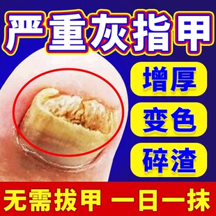 专治疗去灰指甲专用药水膏脱甲除特正品旗舰店真菌感染效甲沟炎