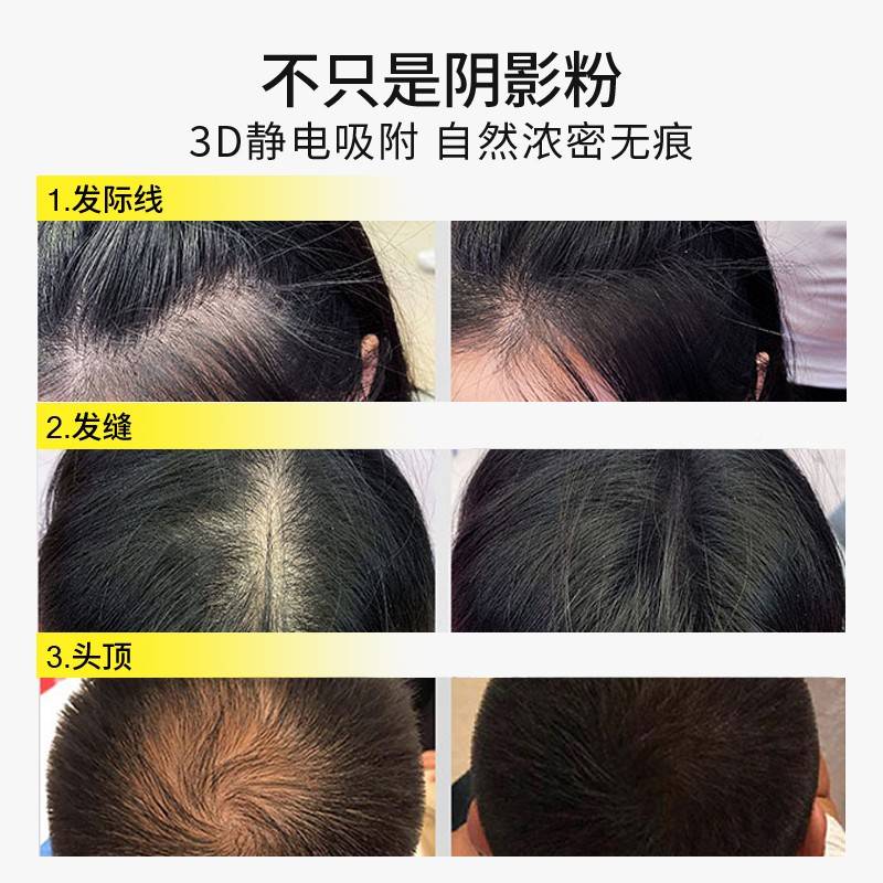 电维动【】纤粉增发套补发秃器量增多际线充发头顶稀填LGN餐少假