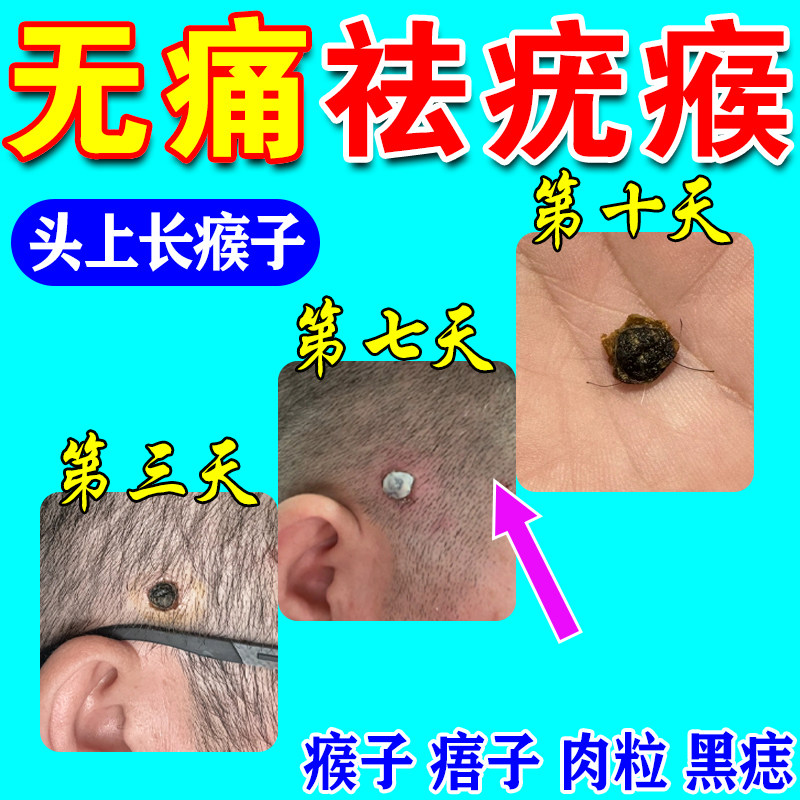 头上长瘊子疣瘊灵去除脖子小肉粒祛猴子头发里肉刺疙瘩黑痣痦子膏