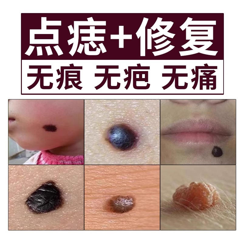 点痣膏点痣药水不留疤美容院专用面部健康