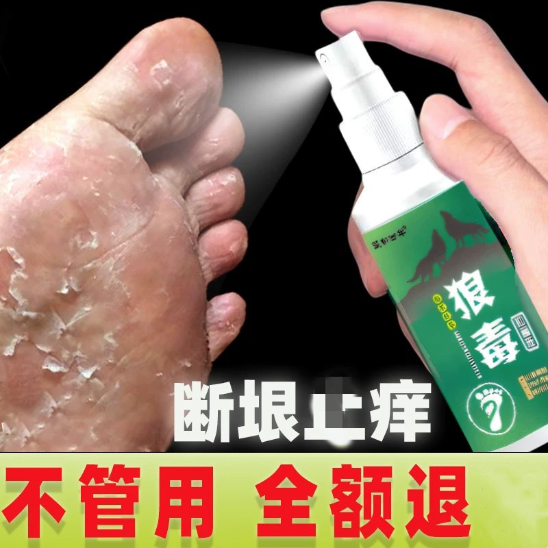 狼毒治脚气喷剂止痒脱皮杀菌真菌感染专用特效喷雾烂脚丫糜烂脚趾