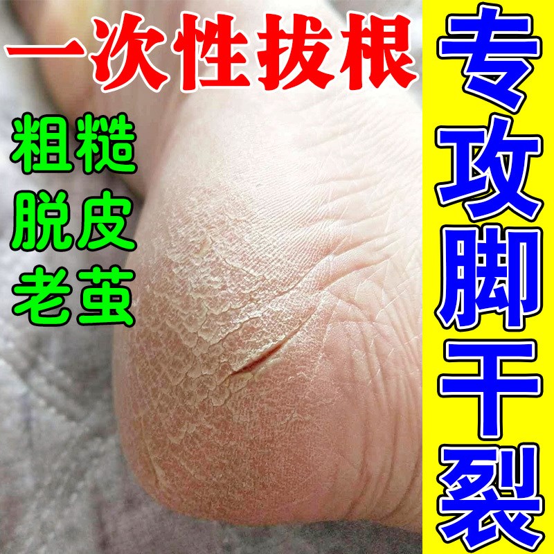 脚后跟干裂起硬h皮足跟开裂专治脚底开裂皲裂去死皮真菌感染修护