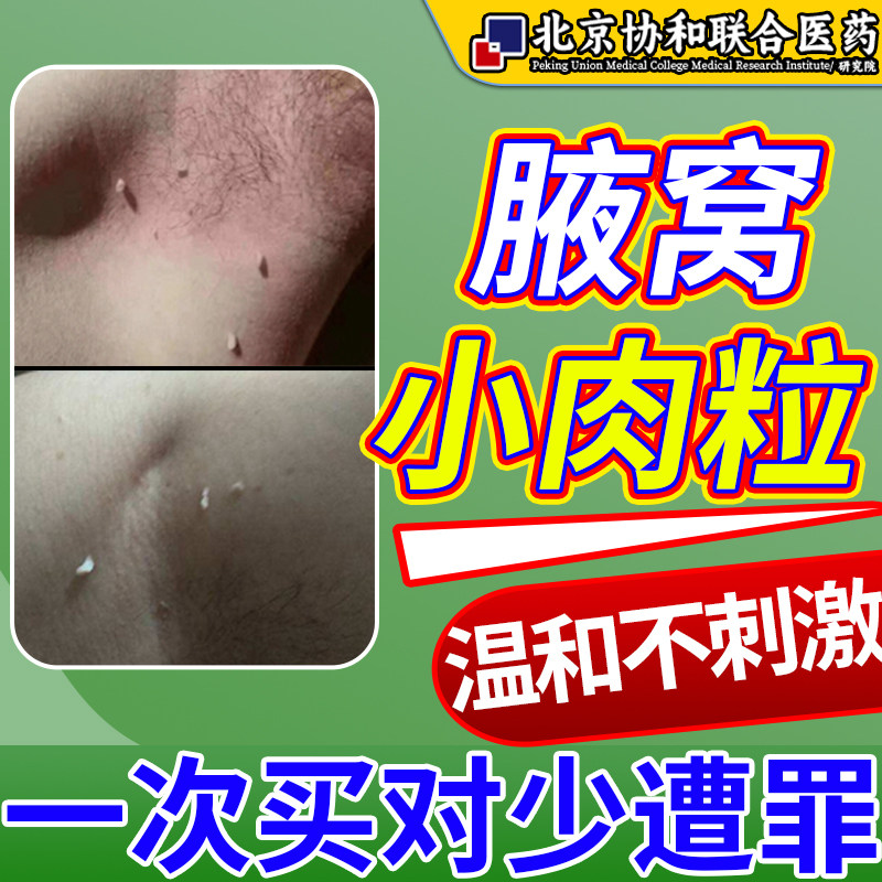去腋下丝状疣扁平疣去除膏医用去尤瘊腋窝下小肉粒疙瘩赘肉kj
