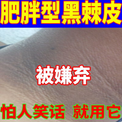 脖子黑棘皮肥胖导致