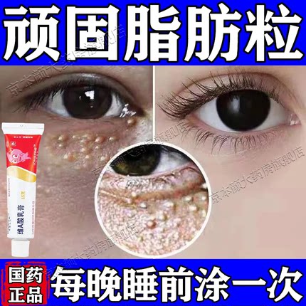 脂肪粒药膏眼周脂肪粒油脂粒汗管瘤白颗粒去疣医用正品维A酸乳膏