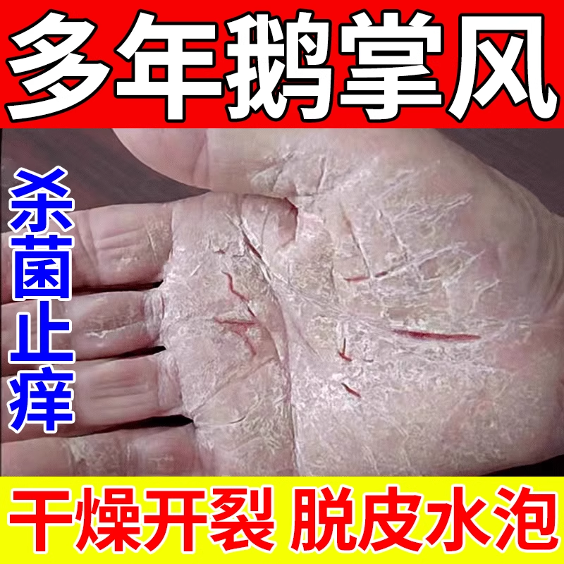 华佗膏治疗鹅掌风专用药膏正品手癣膏脱皮干裂真菌感染止痒用